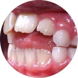 crooked teeth in circle picture